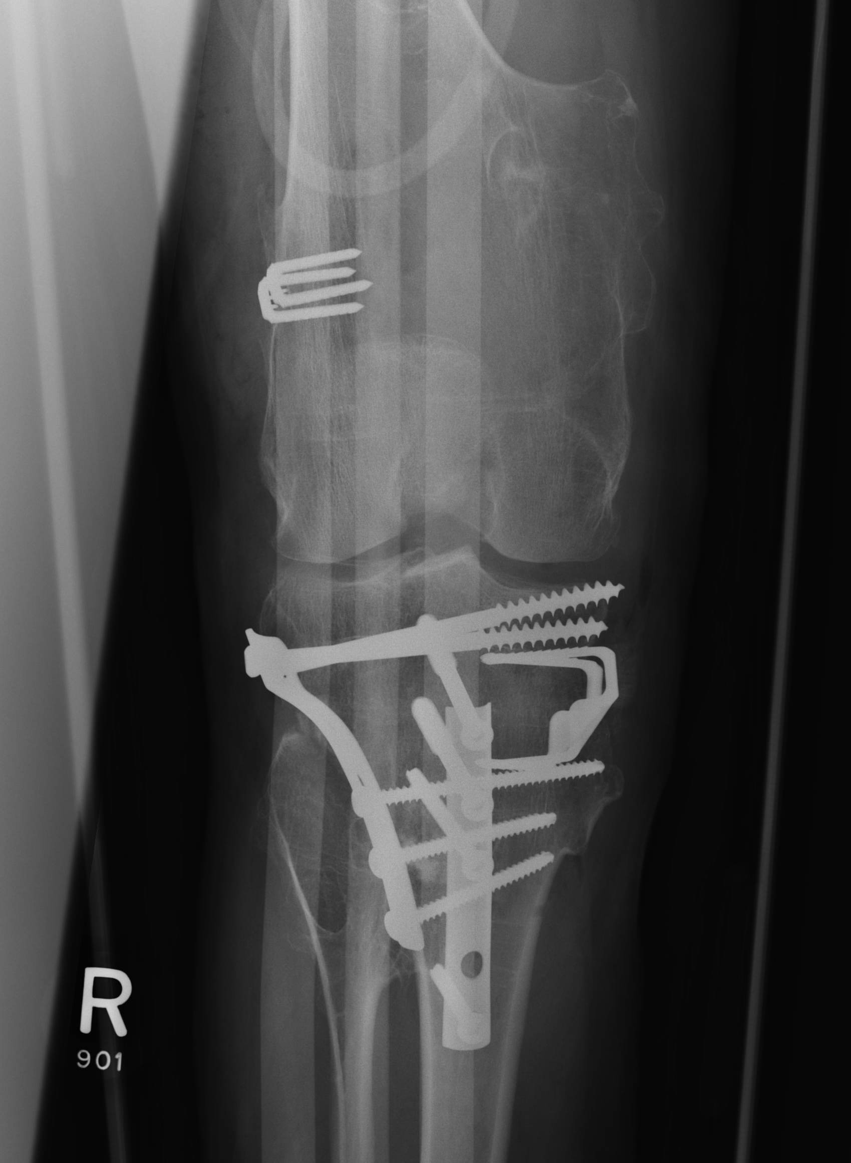 Osteochondromas Knee Osteotomy AP